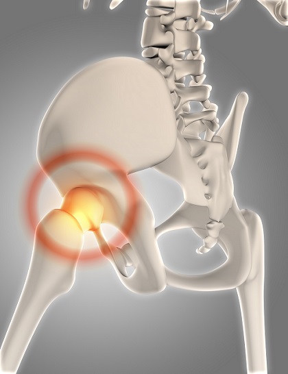 Hip Replacement Surgery in Ahmedabad - Dr Saurabh Goyal